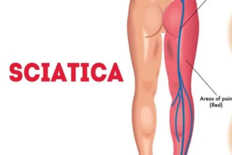 Sciatica Treatment Ayurveda
