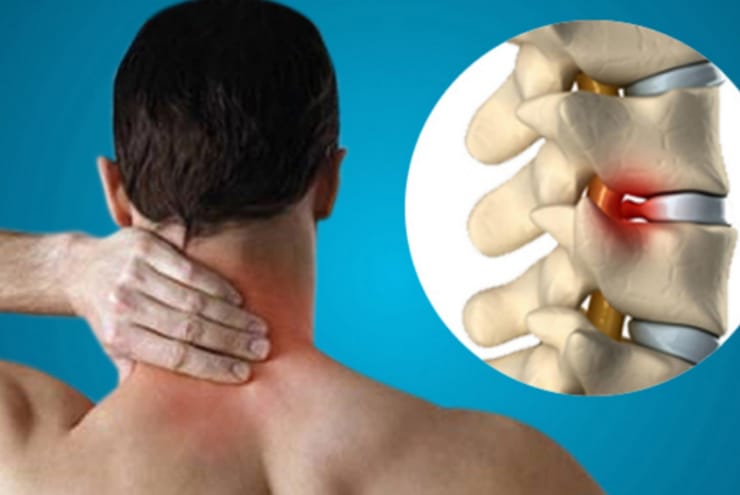 Ayurvedic Spondylitis Treatment