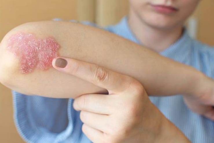 Ayurvedic Psoriasis Treatment